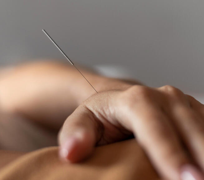 Acupuncture